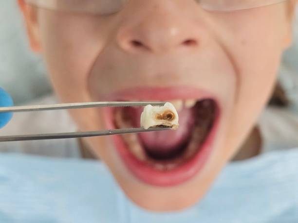 Teeth Whitening in KY